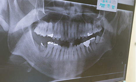 天然歯をできる限り保存