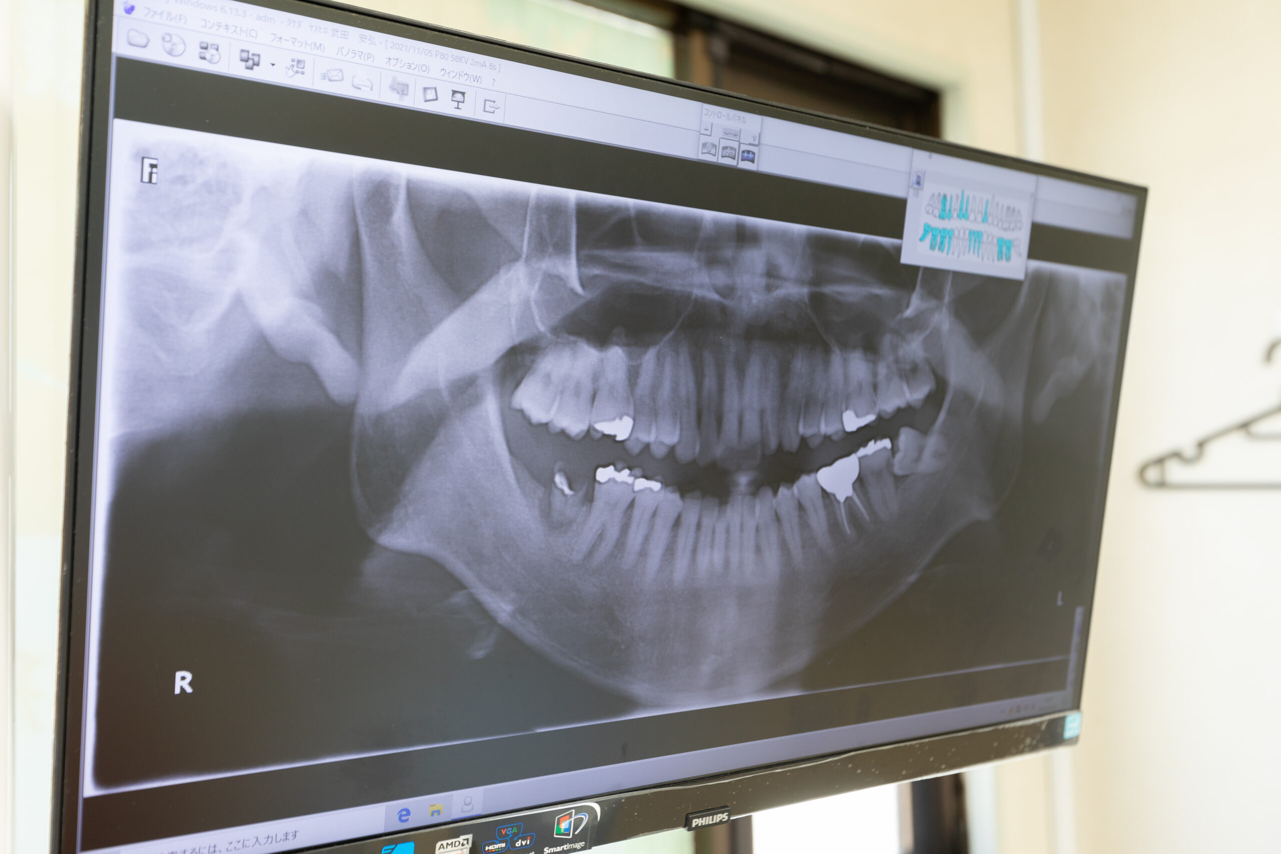 デジタルレントゲンシステム